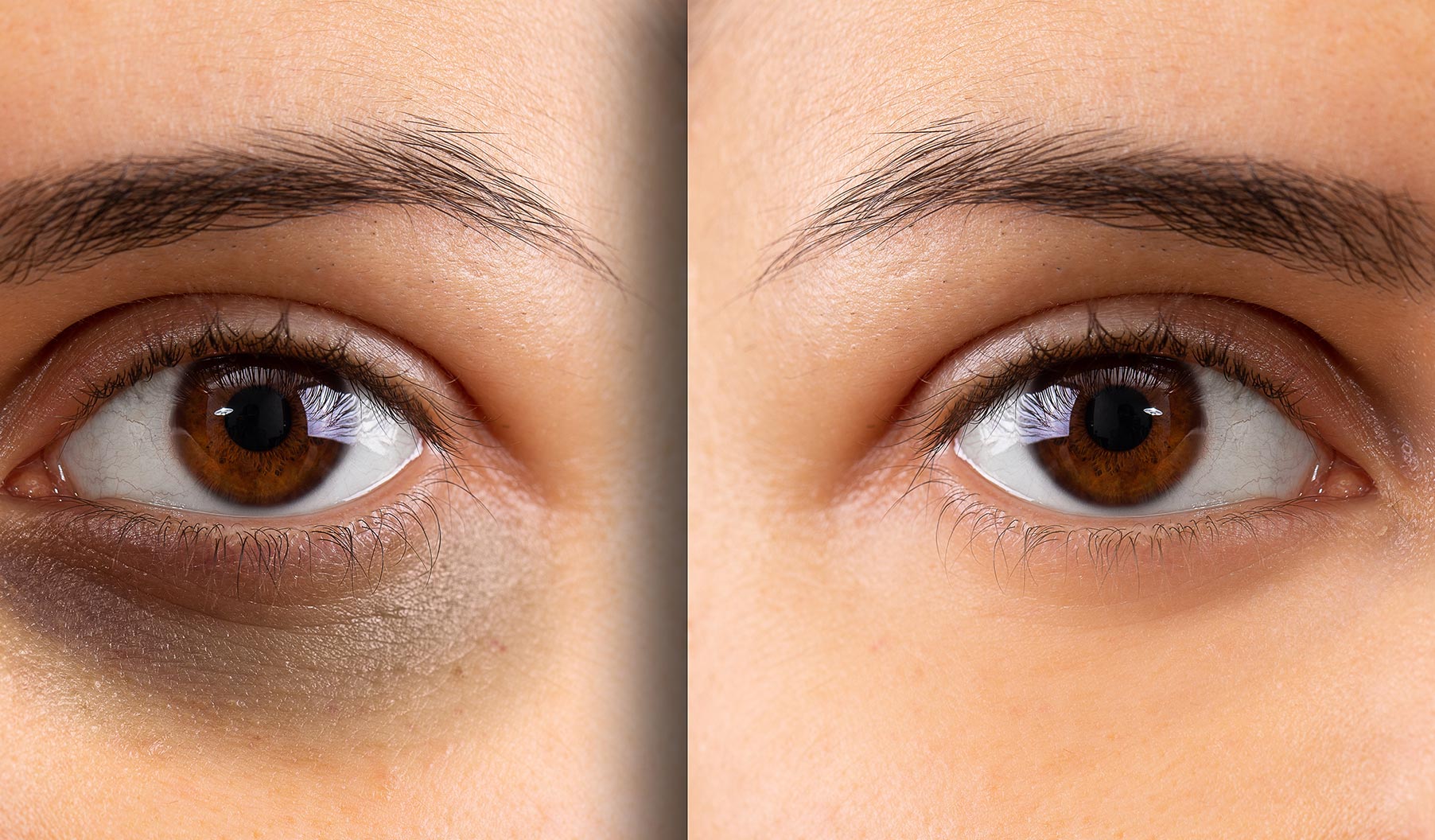 DARK CIRCLES UNDER THE EYES – Rohini ENT Clinic