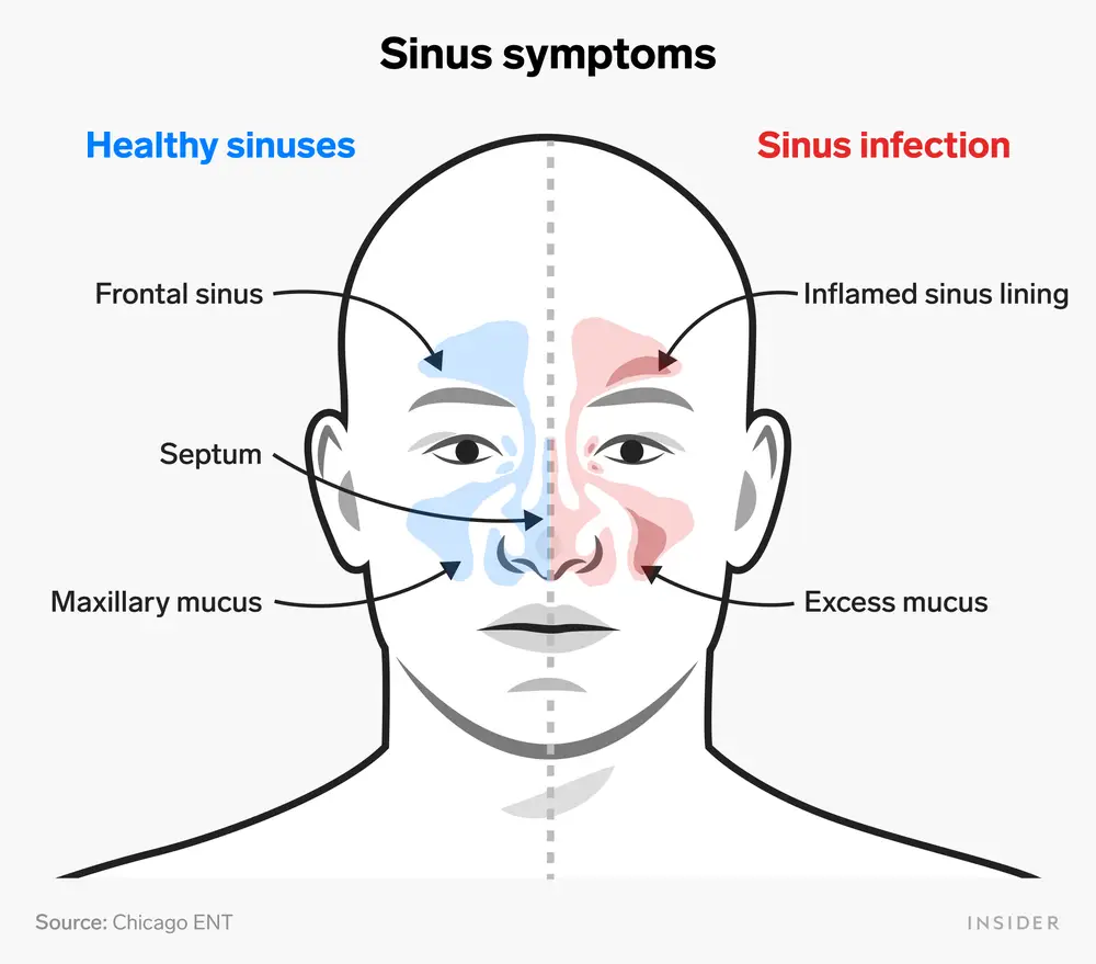 Sinus Infection Chicago, Sinusitis Chicago